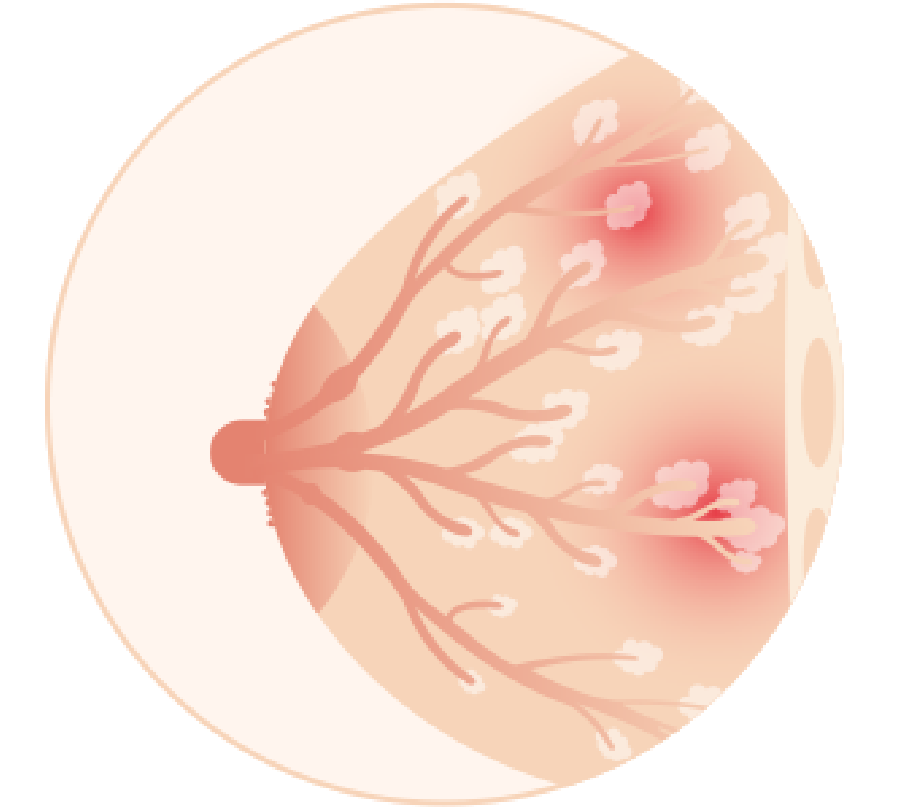乳腺炎通常發生在產後開始哺乳的2~3週